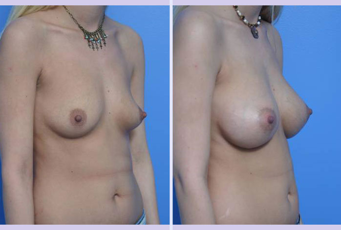 Before and After Image: breast augmentation – Case 1 - right-front-oblique