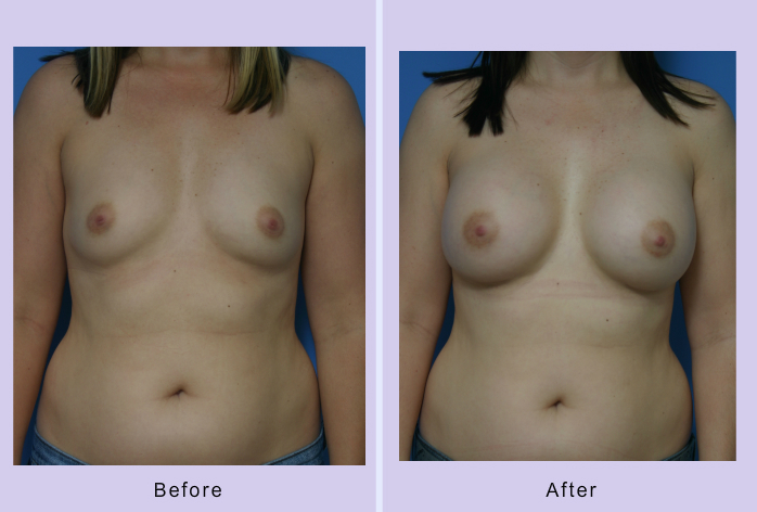 Before and After Image: breast augmentation – Case 27 - front
