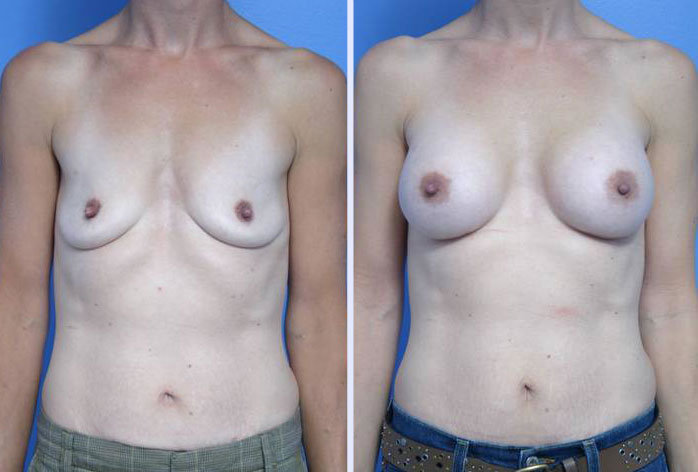 Before and After Image: breast augmentation – Case 17 - front