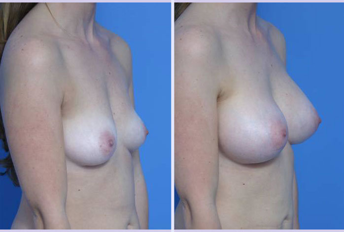Before and After Image: breast augmentation – Case 7 - right-front-oblique