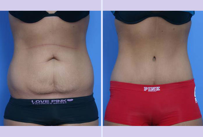 Before and After Image: abdominoplasty – tummy tuck – Case 8 - front