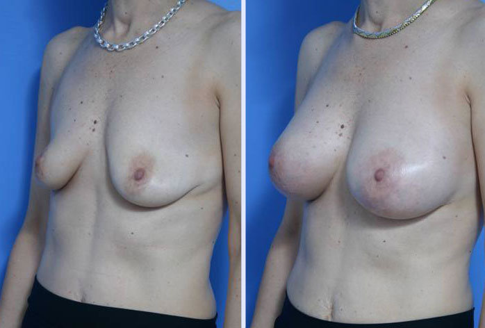 Before and After Image: breast augmentation – Case 10 - left-front-oblique