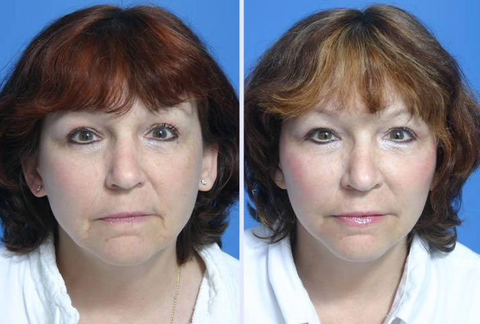 Before and After Image: 3-d volumetric facelift – case 11 - front