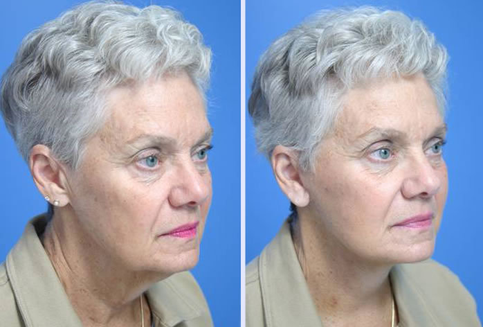 Before and After Image: facelift and mini facelift – case 3 - front
