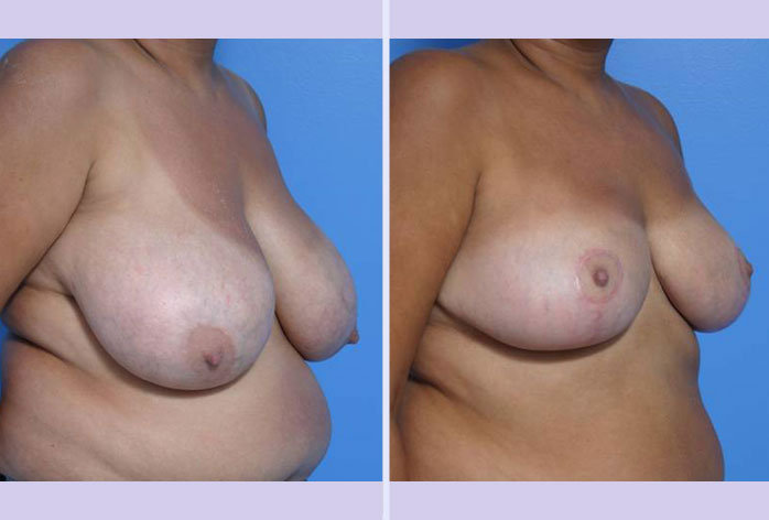 Before and After Image: breast reduction – case 2 - right-front-oblique