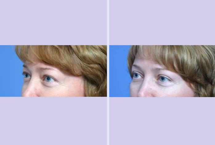Before and After Image: blepharoplasty – case 3 - left-front-oblique