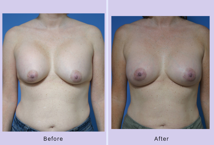 Before and After Image: breast correction – case 9 - front