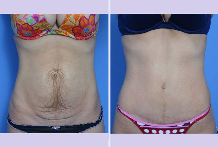 Before and After Image: abdominoplasty – tummy tuck – Case 17 - front