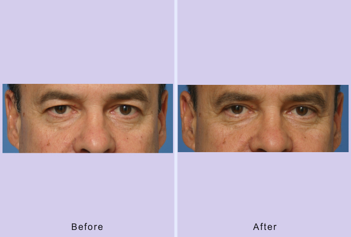 Before and After Image: blepharoplasty – case 12 - front