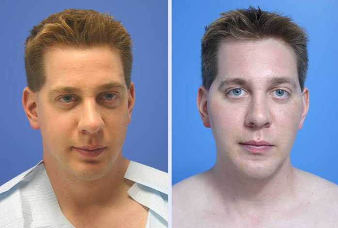 Before and After Image: buccal lipectomy – case 2 - front