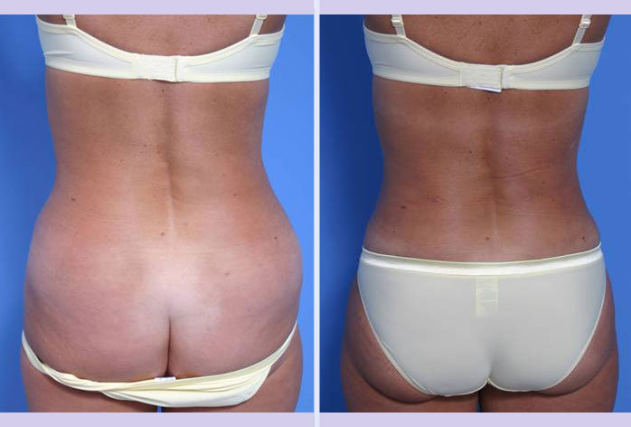 Before and After Image: liposuction – case 8 - back