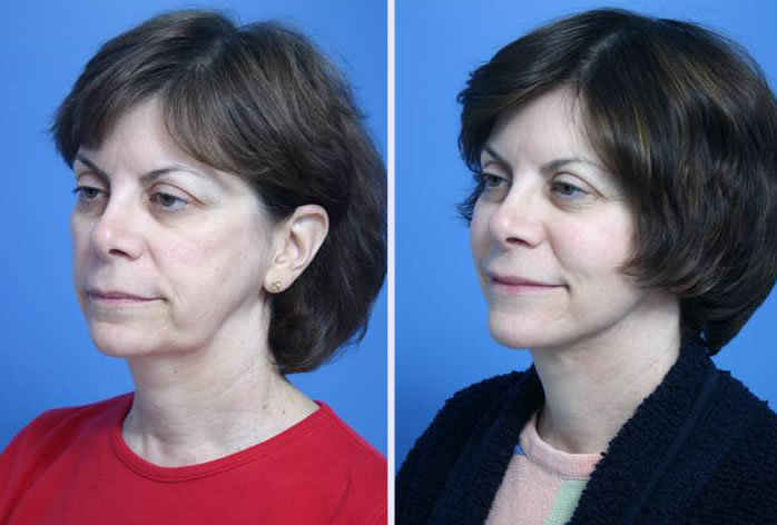 Before and After Image: 3-d volumetric facelift – case 2 - left-front-oblique
