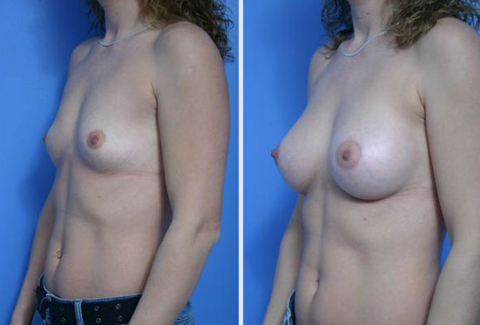 Before and After Image: breast augmentation – Case 9 - left-front-oblique