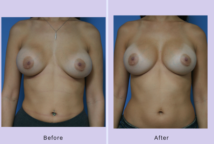 Before and After Image: breast correction – case 11 - front