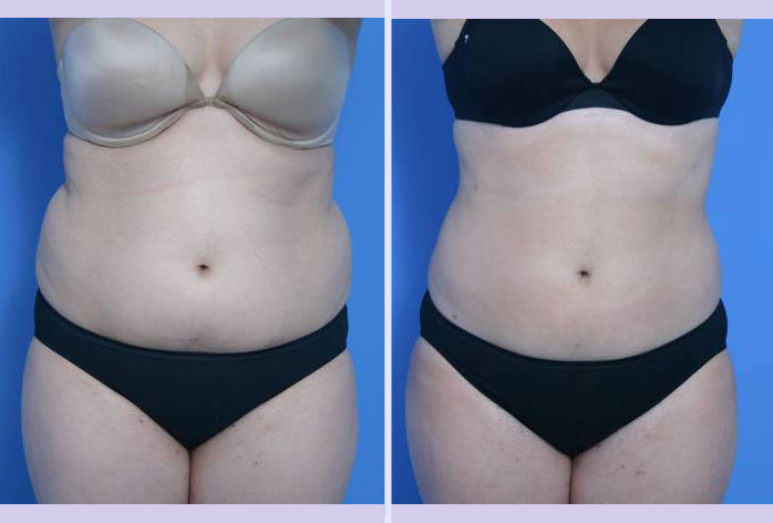 Before and After Image: liposuction – case 2 - front