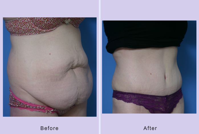 Before and After Image: abdominoplasty – tummy tuck – Case 26 - right-front-oblique