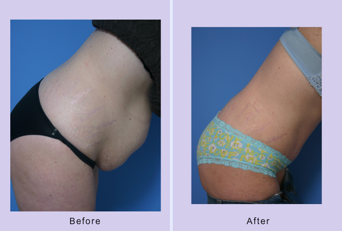 Before and After Image: abdominoplasty – tummy tuck – Case 15 - other