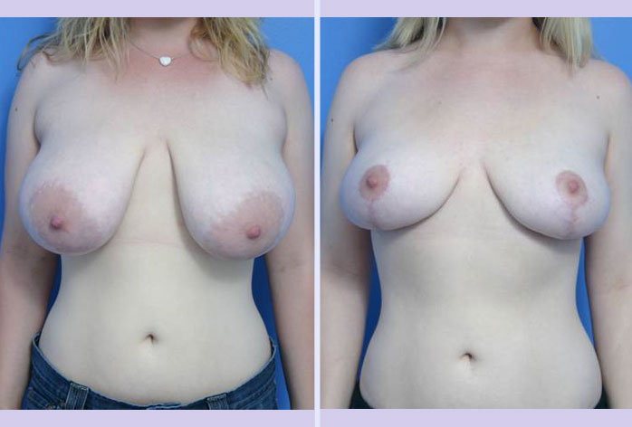 Before and After Image: breast reduction – case 3 - front