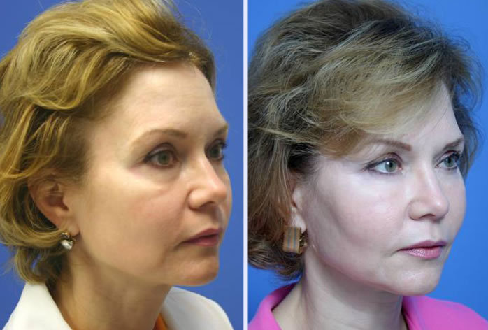 Before and After Image: facial fat grafting – case 5 - right-front-oblique