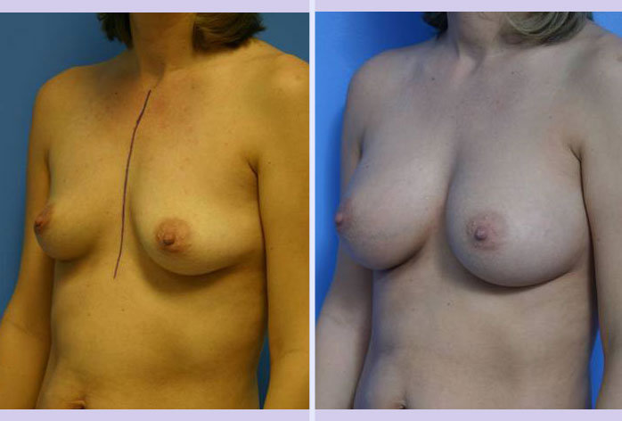 Before and After Image: breast augmentation – Case 2 - left-front-oblique