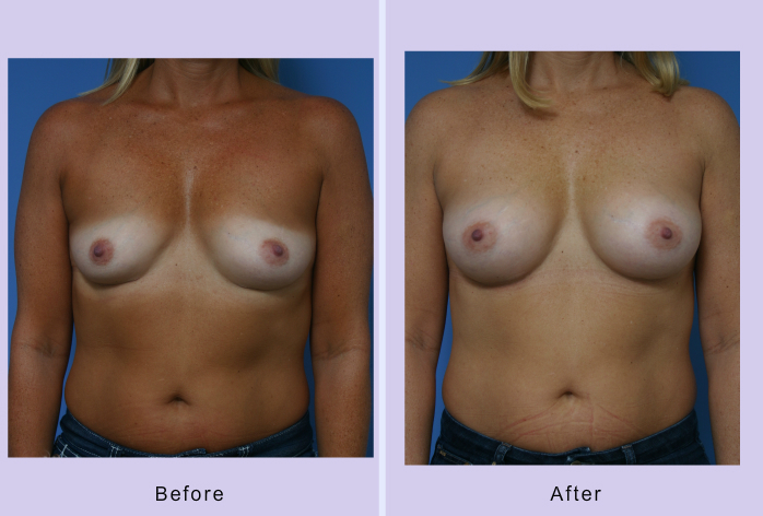 Before and After Image: breast augmentation – Case 24 - front