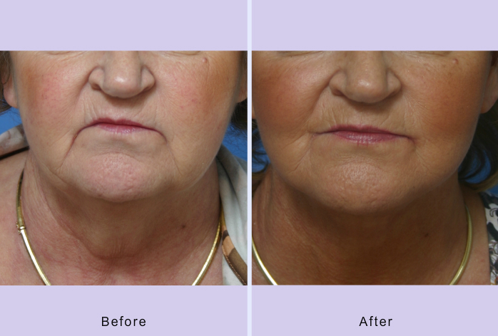 Before and After Image: grin lift – corner mouthlift - front