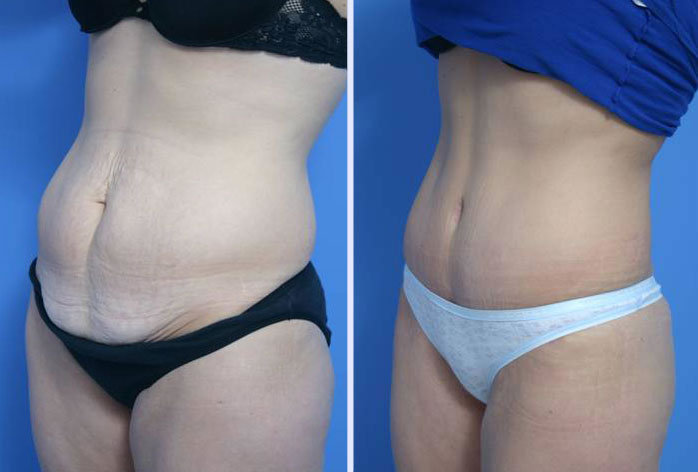 Before and After Image: abdominoplasty – tummy tuck – Case 10 - left-front-oblique