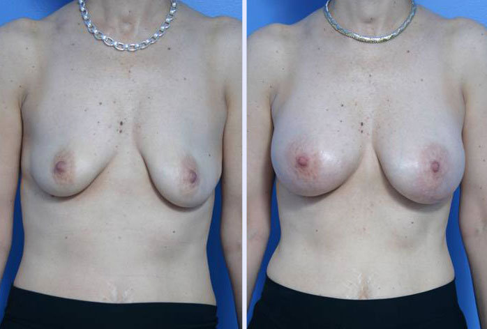 Before and After Image: breast augmentation – Case 10 - front