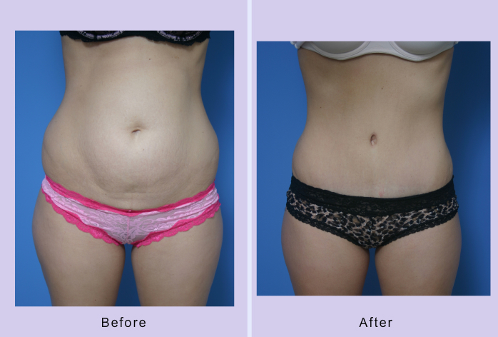 Before and After Image: abdominoplasty – tummy tuck – Case 18 - front
