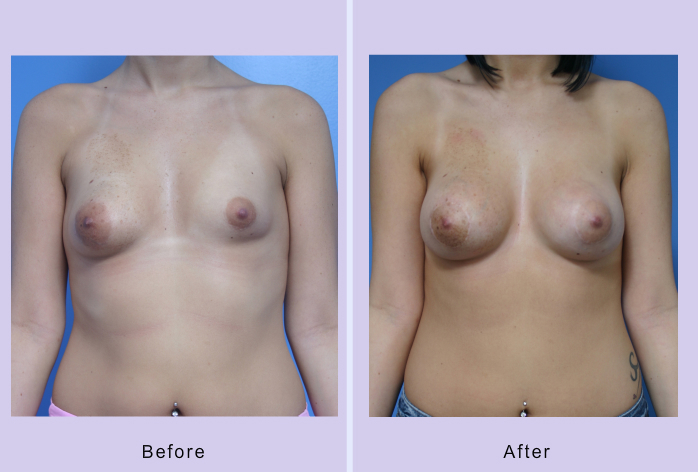Before and After Image: breast correction – case 7 - front