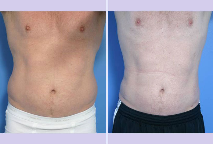 Before and After Image: liposuction – case 1 - front