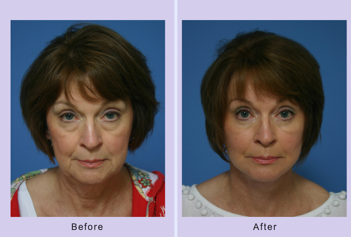 Before and After Image: facelift and mini facelift – case 5 - front