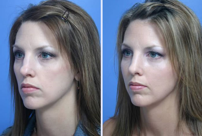 Before and After Image: facial fat grafting – case 8 - left-front-oblique