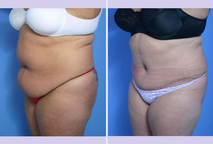 Before and After Image: abdominoplasty – tummy tuck – Case 25 - left-front-oblique