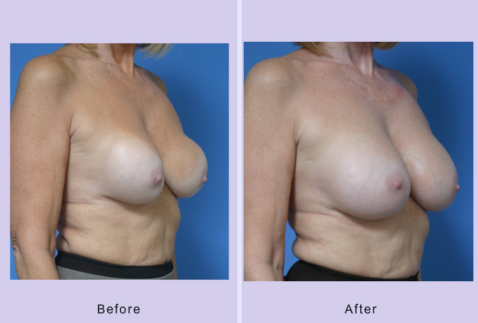 Before and After Image: breast correction – case 6 - right-front-oblique