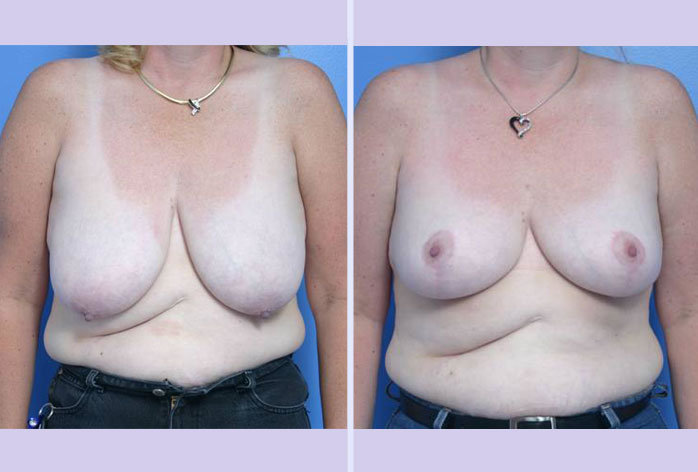Before and After Image: breast reduction – case 1 - front