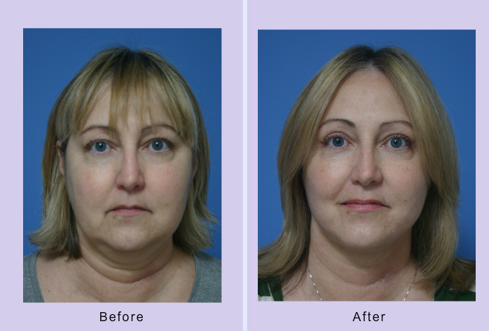 Before and After Image: facial reshaping – case 1 - front