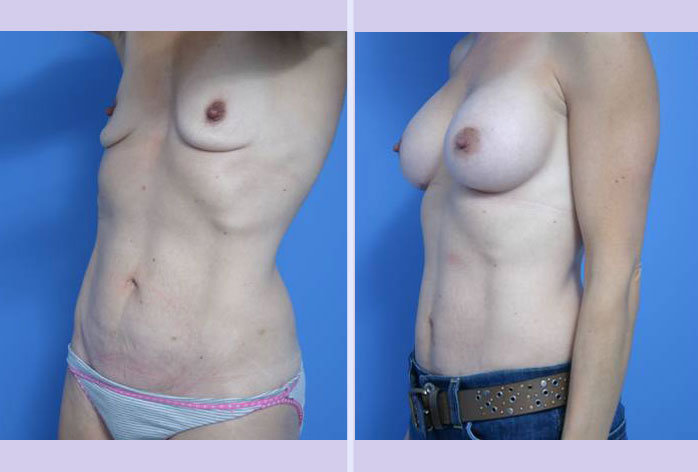 Before and After Image: mommy makeover – case 1 - left-front-oblique