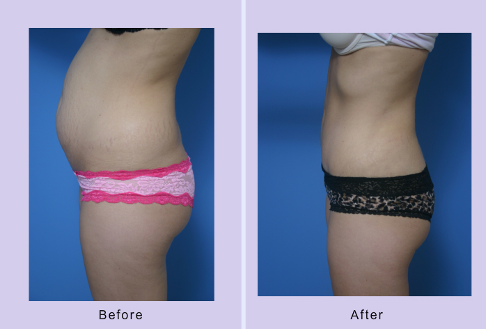 Before and After Image: abdominoplasty – tummy tuck – Case 18 - left-side