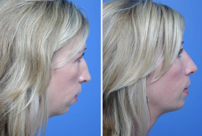 Before and After Image: rhinoplasty – case 4 - other