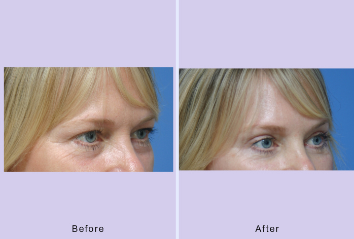 Before and After Image: blepharoplasty – case 11 - right-front-oblique