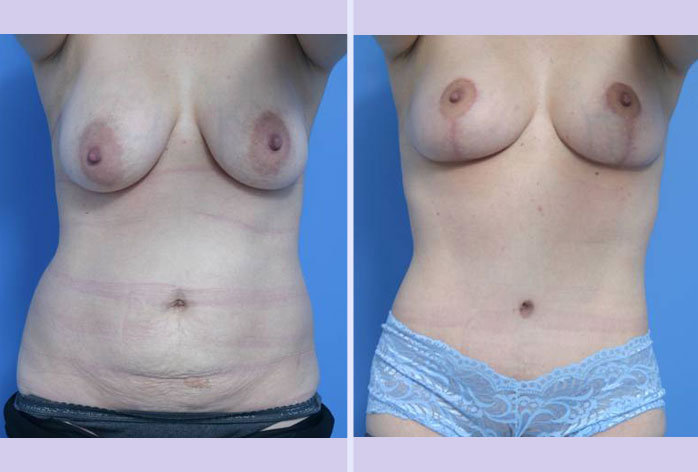 Before and After Image: mommy makeover – case 3 - front