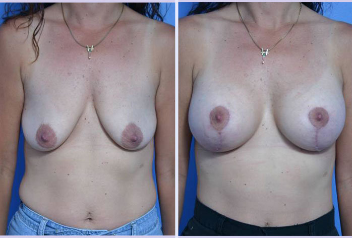 Before and After Image: breast lift – case 4 - front