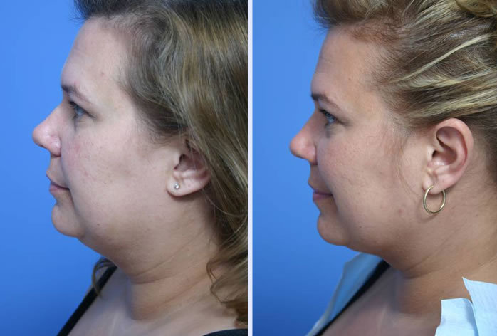 Before and After Image: submental liposuction – case 3 - left-side