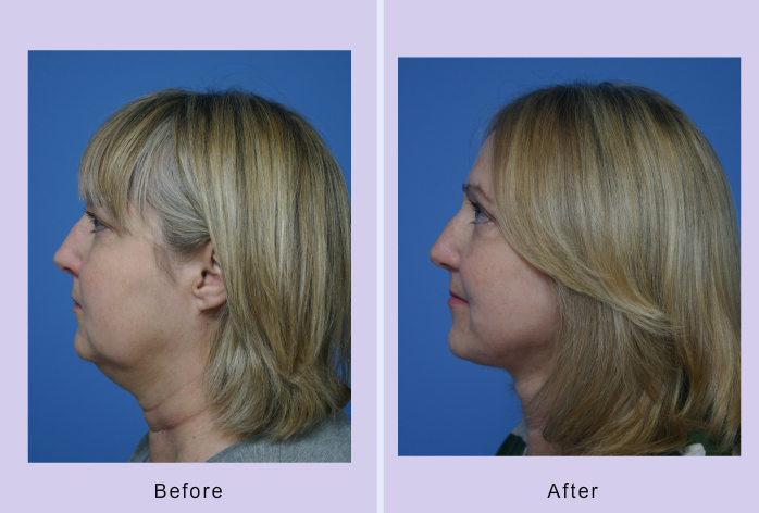 Before and After Image: facelift and mini facelift – case 2 - left-side