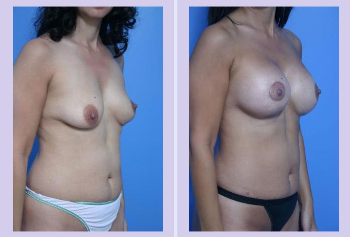 Before and After Image: breast lift – case 10 - right-front-oblique