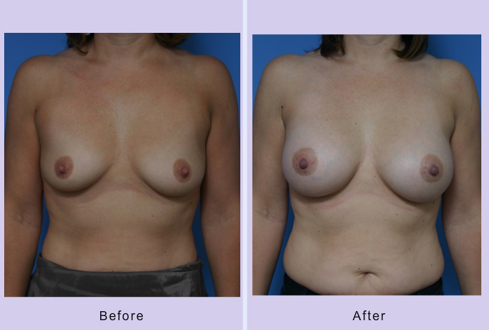 Before and After Image: breast augmentation – Case 23 - front