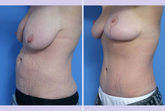 Before and After Image: mommy makeover – case 2 - left-front-oblique