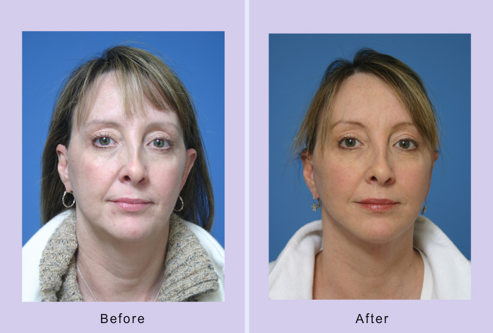 Before and After Image: facelift and mini facelift – case 9 - front