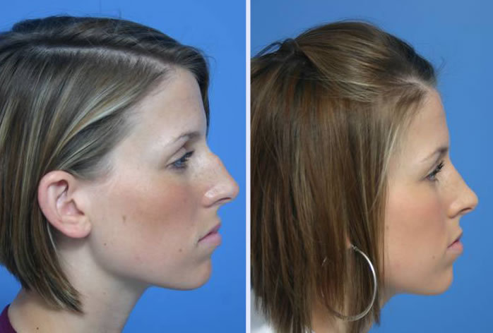 Before and After Image: rhinoplasty – case 5 - right-side
